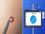 MOLLI Surgical Introduces OncoPen: A Revolutionary Tool in Breast Cancer Surgery