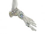 Medline UNITE Earns FDA 510(k) Clearance for REFLEX HYBRID Nitinol Implant System