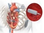 EBR Systems Secures FDA Approval for WiSE System to Treat Advanced Heart Failure