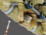 CGBIO's NOVOSIS PUTTY Wins FDA IDE Approval for US Spinal Trial