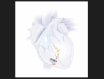 FDA-Approved WiSE System Begins US Rollout for Leadless Heart Pacing