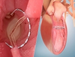 Ancora Heart Hits Enrollment Goal in CORCINCH-HF Trial for HFrEF Therapy