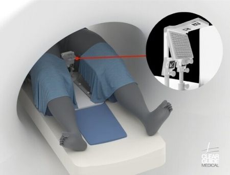Clear Guide Medical Receives FDA Clearance for SCENERGY System