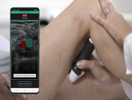 Clarius and ThinkSono Introduce New AI-Guided Ultrasound System Enabling Rapid Assessments of DVTs