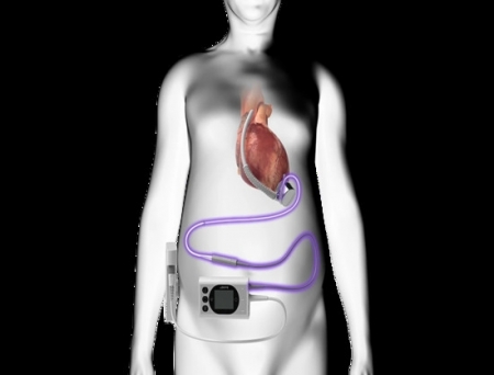 BrioHealth Solutions Receives FDA Approval to Begin Trial for Advanced Heart Failure Solution