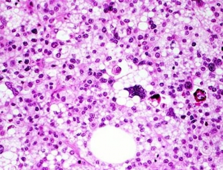 Philogen Completes Patient Enrollment of Phase III FIBROSARC Trial in STS
