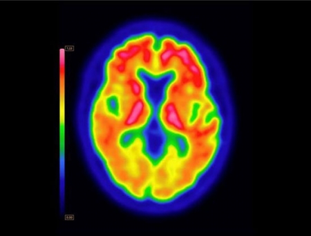 US FDA Approves Expanded Indications for GE HealthCare's Vizamyl PET Imaging Agent