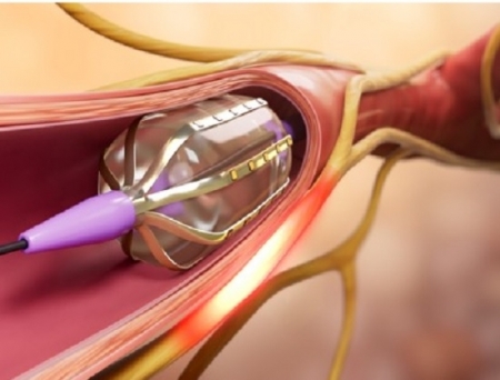 Autonomix Secures New European Patent for Catheter-Based Technology