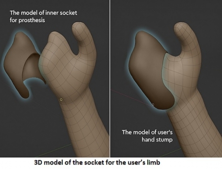 Motorica Introduces Digital Prosthetics to India