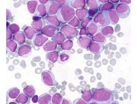 Teiko, University of Utah Collaborate on AML MRD Testing