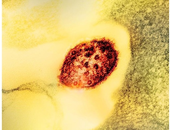 Researchers Discover First Human Antibody Panel Targeting Measles Virus